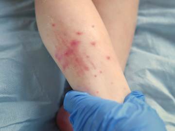 Parents Whose Child Died of Measles Spark Outrage With… 