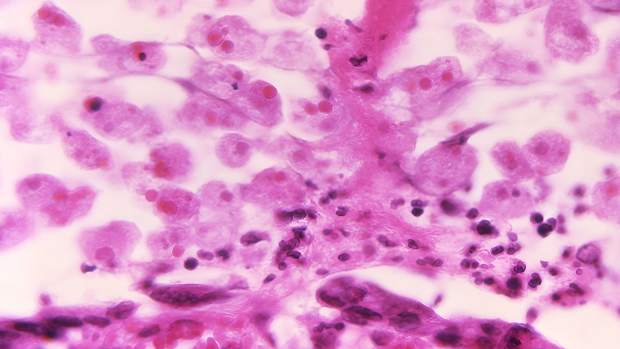 Under a magnification of 500X, this photomicrograph of a sample of intestinal mucosa, revealed the histopathologic changes associated with an amebiasis infection due to the parasitic organism, Entamoeba histolytica. In this view, youre able to see numerous E. histolytica trophozoites, many of which contain ingested by red blood cells (RBCs), which these amoeba engulfed through a process known as erythrophagocytosis. CDC 1970. (Photo by: CDC/IMAGE POINT FR/BSIP/Universal Images Group via Getty Images)