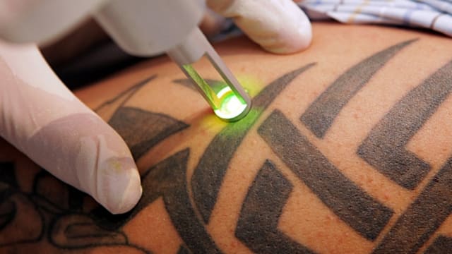 Best Tattoo Removal Treatments in Aylesbury | Fresha