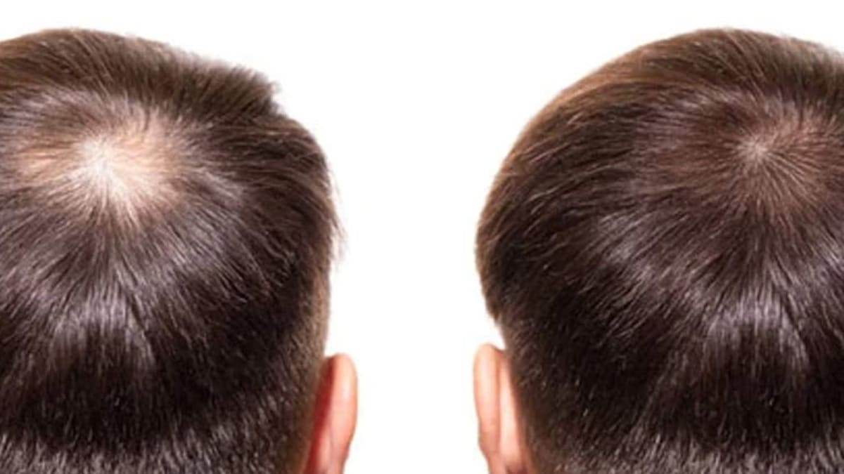 Prevent Hair Loss And Stimulate Hair Growth With This DHT Blocker - Men's  Journal