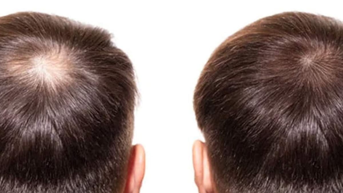 Prevent Hair Loss And Stimulate Hair Growth With This DHT Blocker - Men's Journal Prevent Hair Loss And Stimulate Hair Growth With This DHT Blocker - Men's Journal