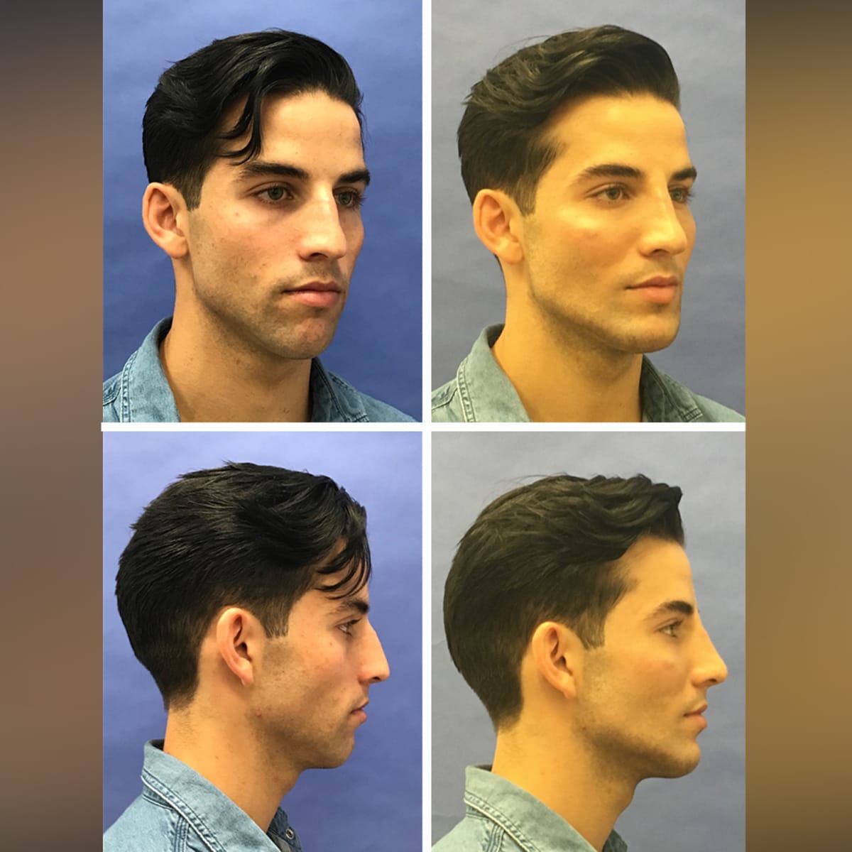 How to Achieve a Chiseled Jawline - Zcosmetic Health