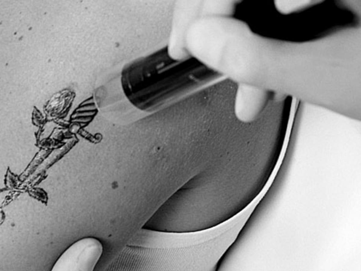 Tattoo Removal Injury | After Personal Injury