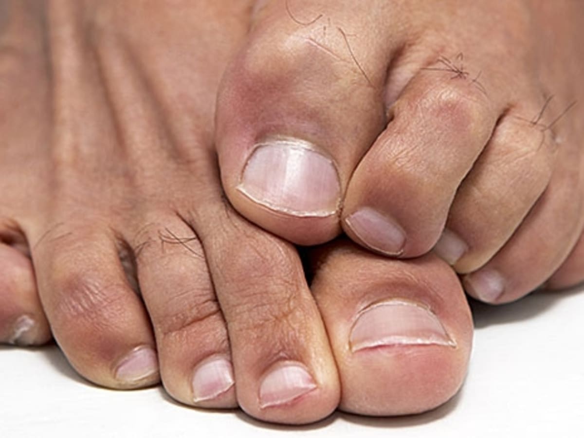 How to Cure Athlete s Foot Men s Journal