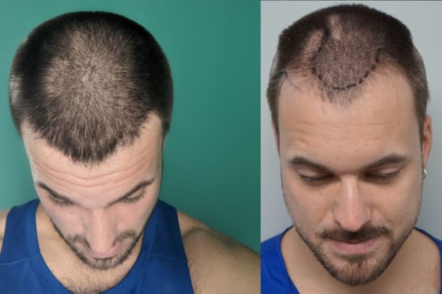 Hair Transplant Surgery: Inside the Procedure and Results | Men's Journal - Men's Journal Hair Transplant Surgery: Inside the Procedure and Results | Men's Journal - Men's Journal