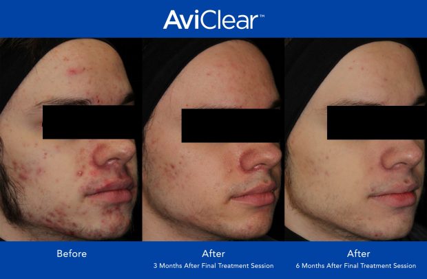 How to Get Rid of Acne: The Fastest Effective Treatments 12 aviclearbeforeafter