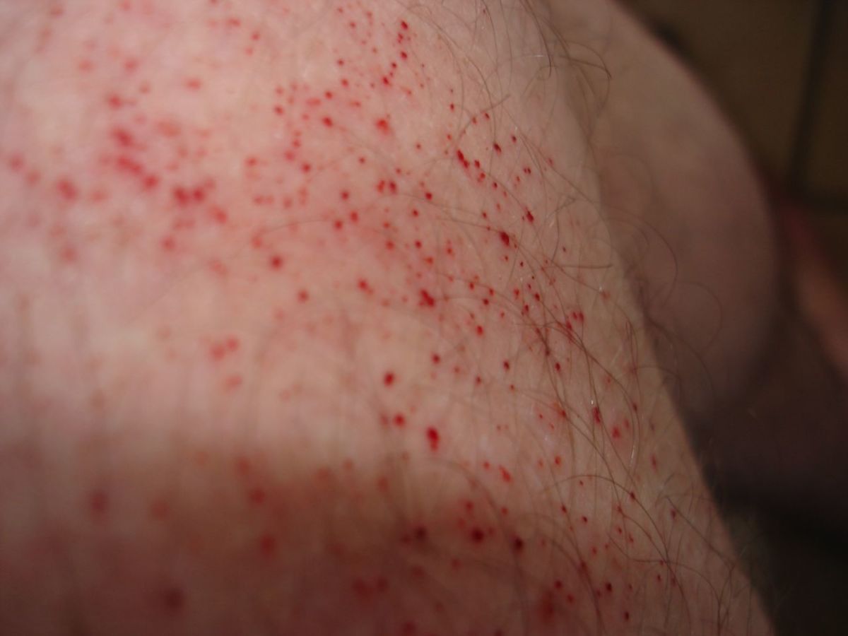 What is Surf Rash and How Can You Treat It? - SETT – SETT Surf