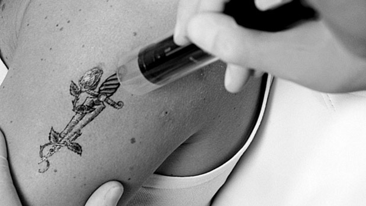 Effective Tattoo Removal Techniques: A Comprehensive Guide