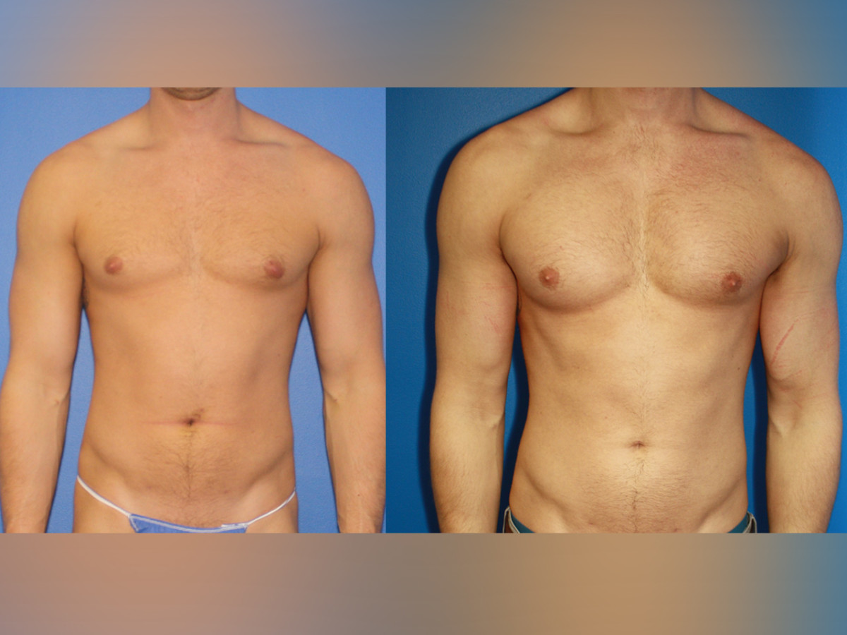 5 Plastic Surgeries That Make Fit Guys Look More Muscular Men's Journal