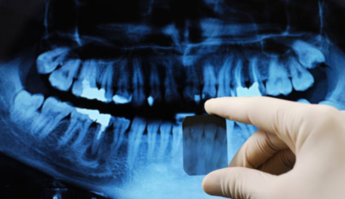 Dental XRays Linked to Brain Tumors Men's Journal