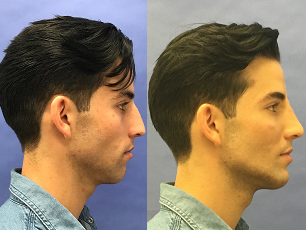 The Latest Uptick in Plastic Surgery: Procedures for Men