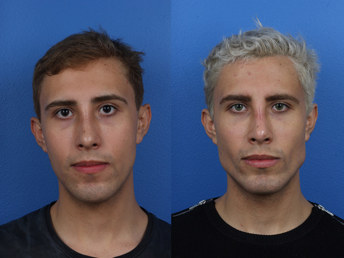 The Latest Uptick in Plastic Surgery: Procedures for Men