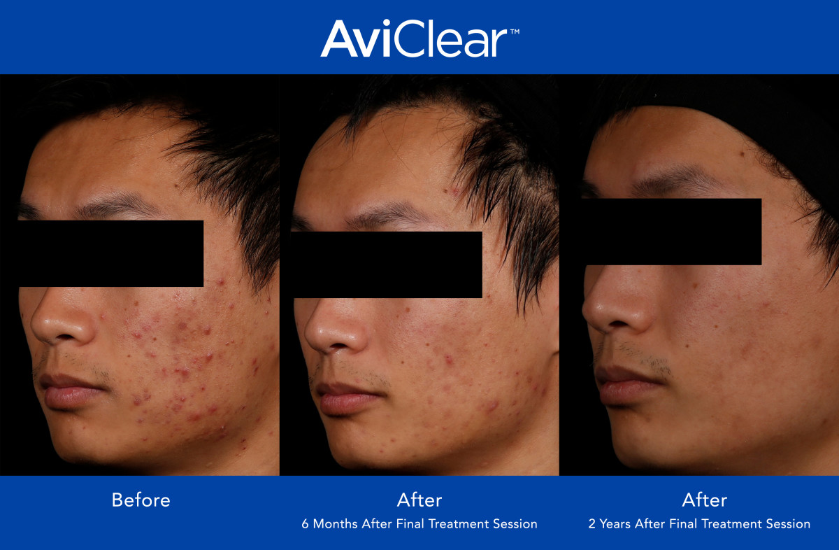 AviClear Review This Acne Laser Treatment Rivals Accutane Men's Journal