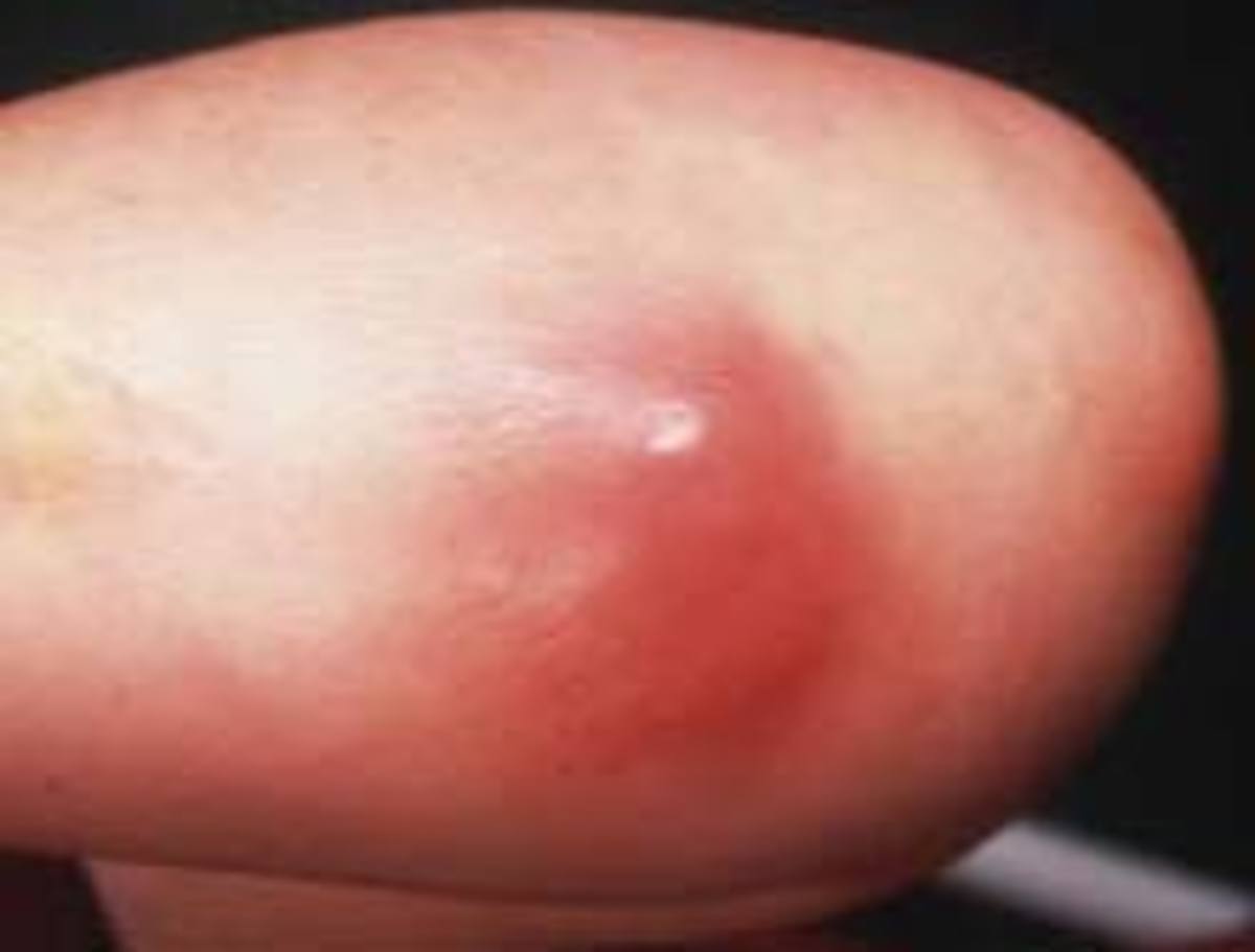 abc Staph Infection