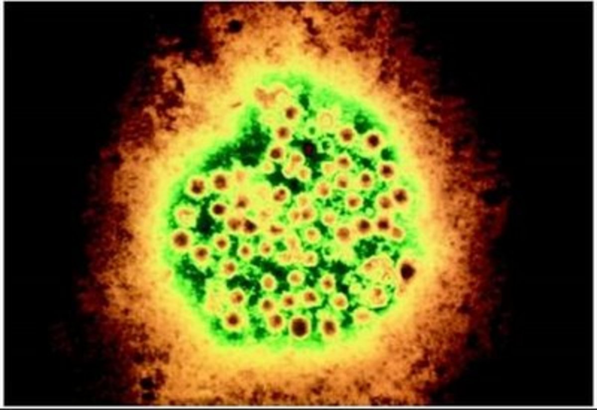 hepatitisa Hepatitis A