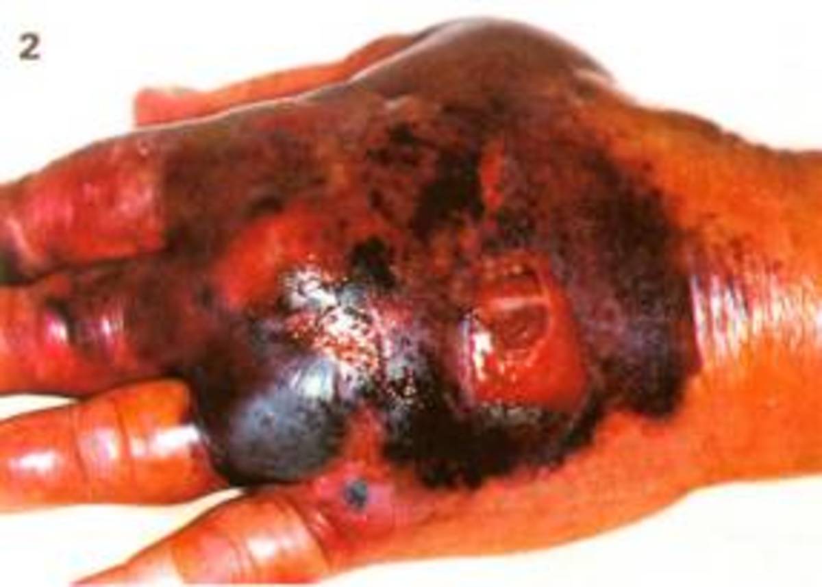 vibriovulnificus vibriovulnificus