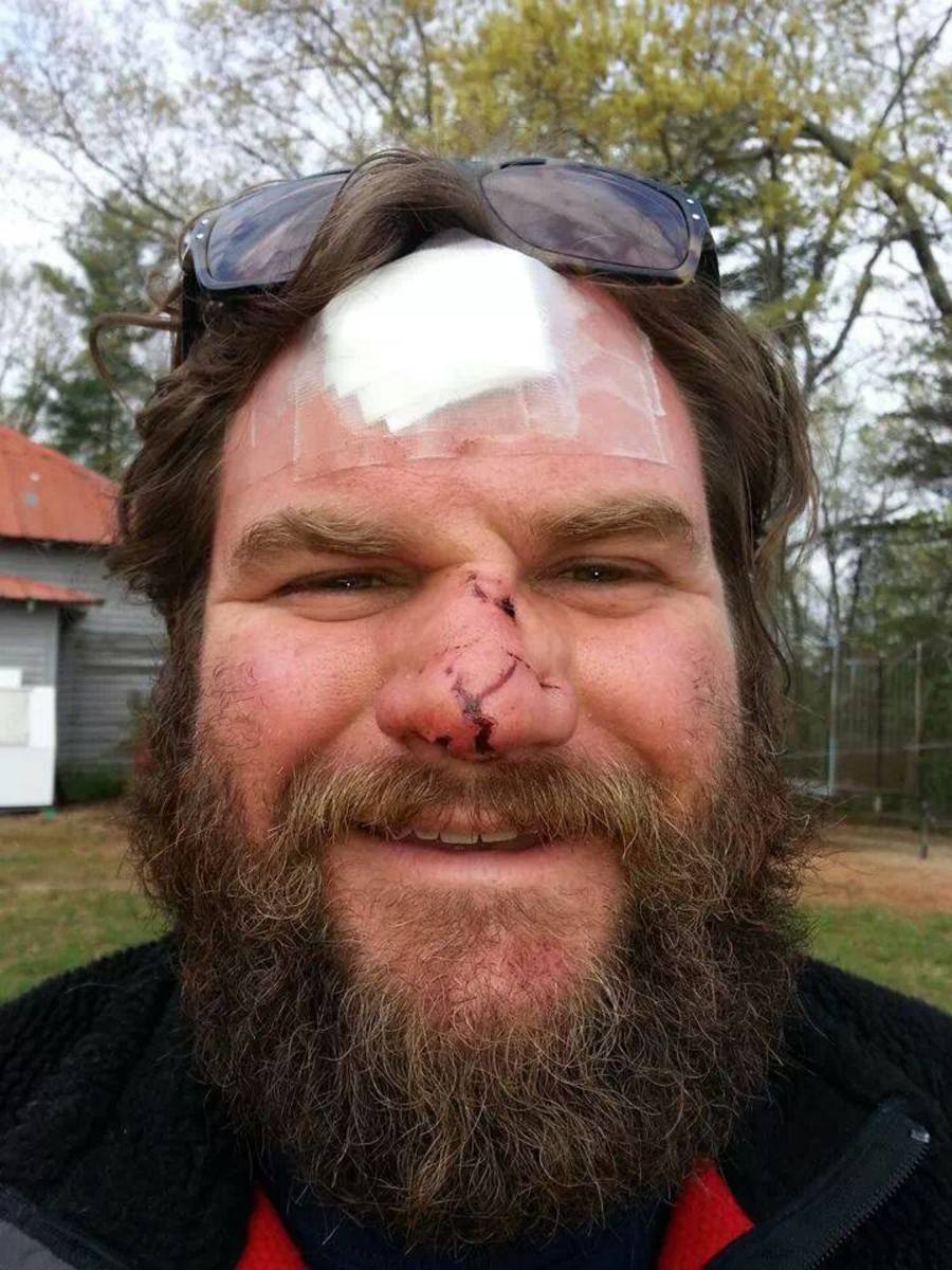 broken nose