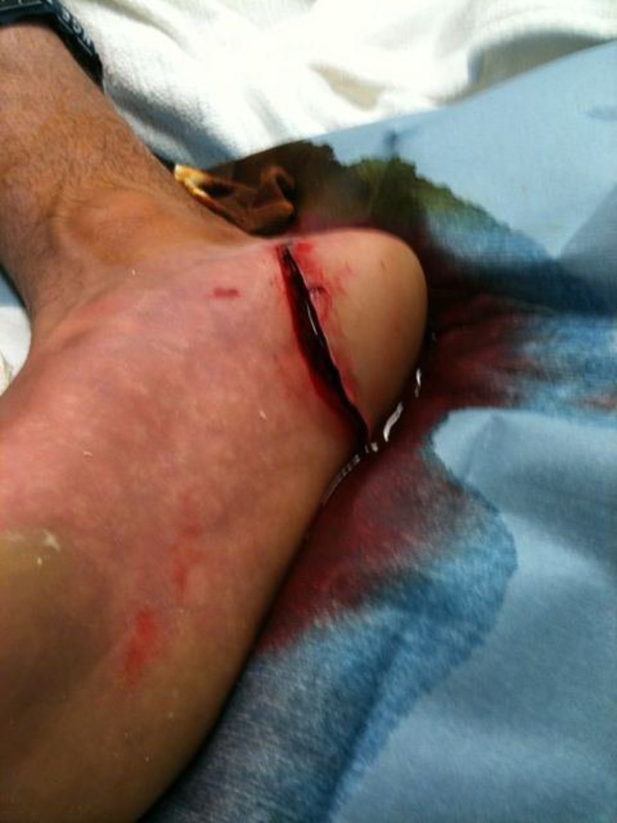 surfing injuries