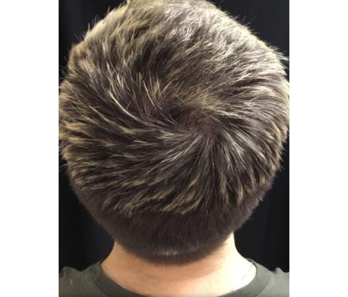 does finasteride regrow hair on the crown