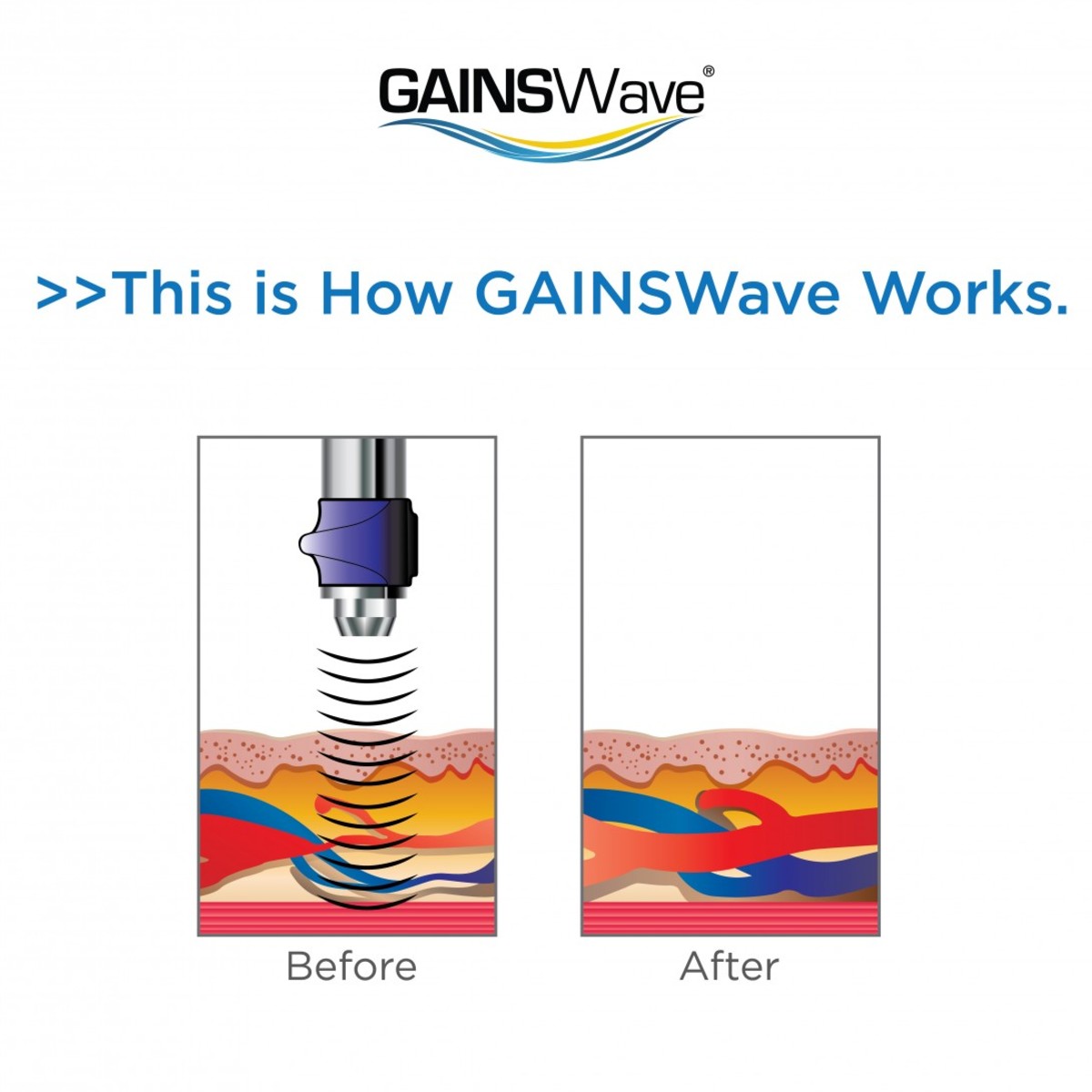 Gainswave