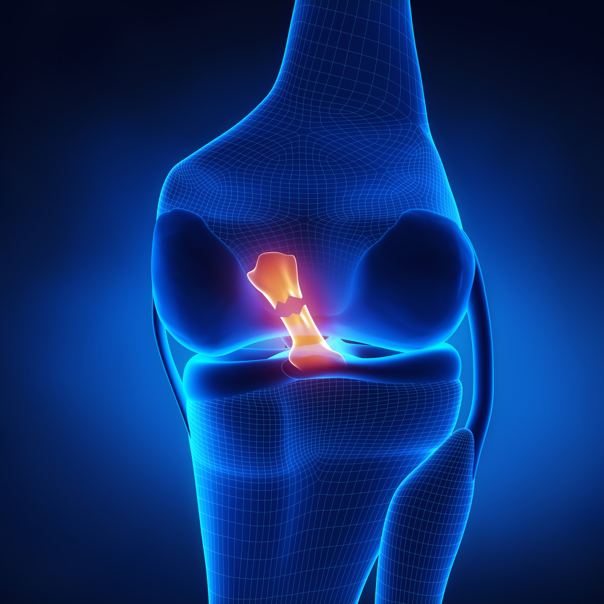 Torn Anterior Cruciate Ligament