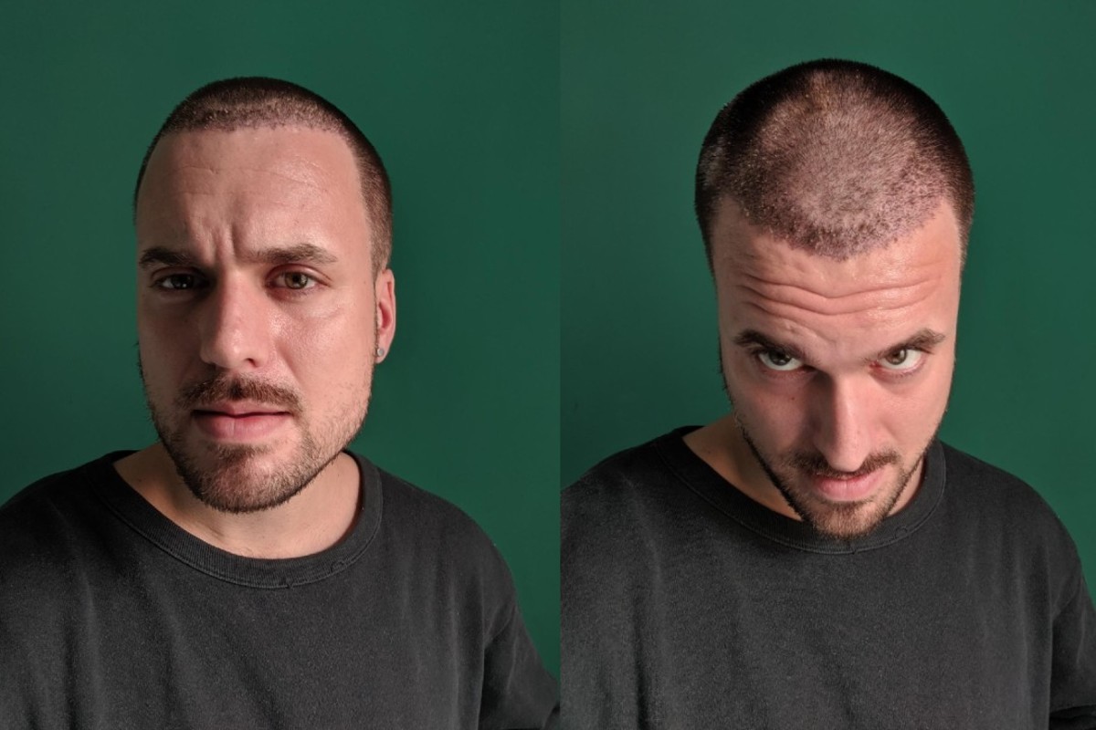 Hair transplant Adam Hurly surgery progress