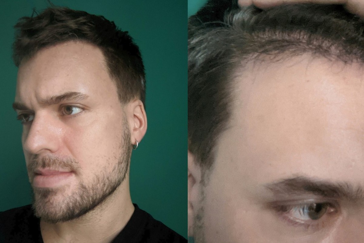 Hair transplant Adam Hurly surgery progress