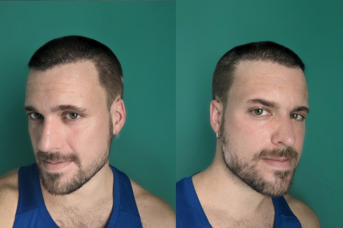 Hair transplant Adam Hurly surgery progress