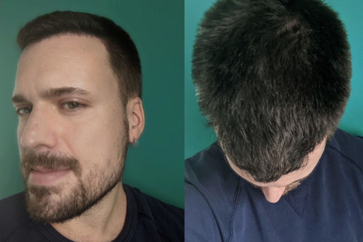 Hair transplant Adam Hurly surgery progress