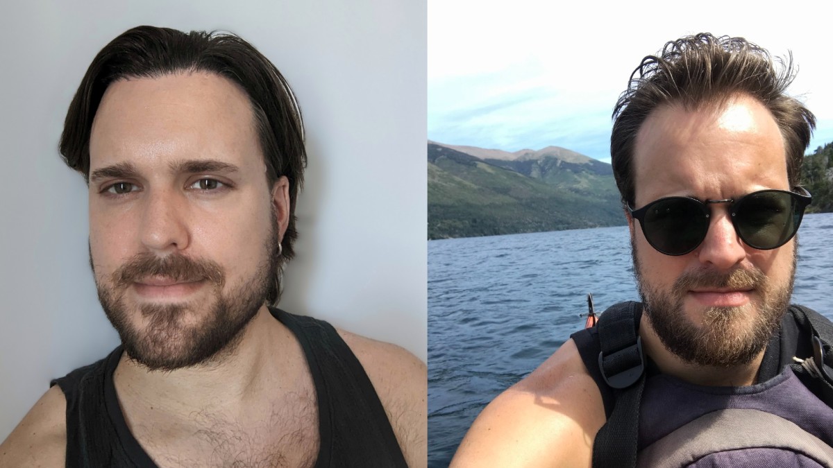 Juxtaposed headshots two years after the hair transplant and before