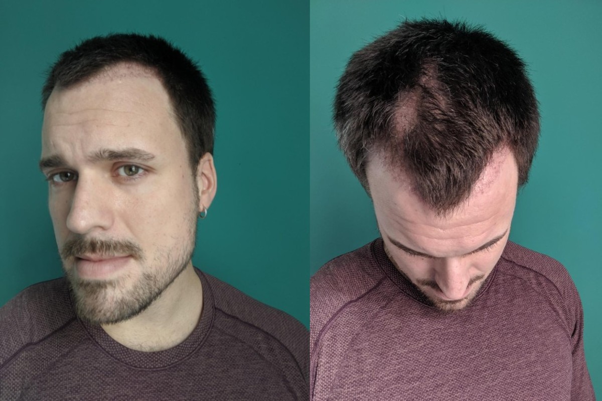 Hair transplant Adam Hurly surgery progress