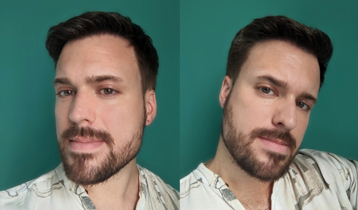 Hair transplant Adam Hurly