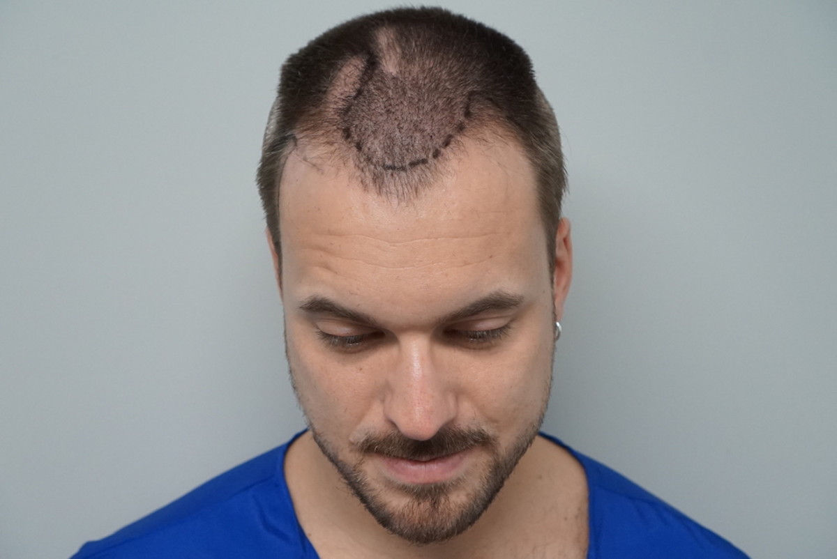 Hurly before hair transplant procedure