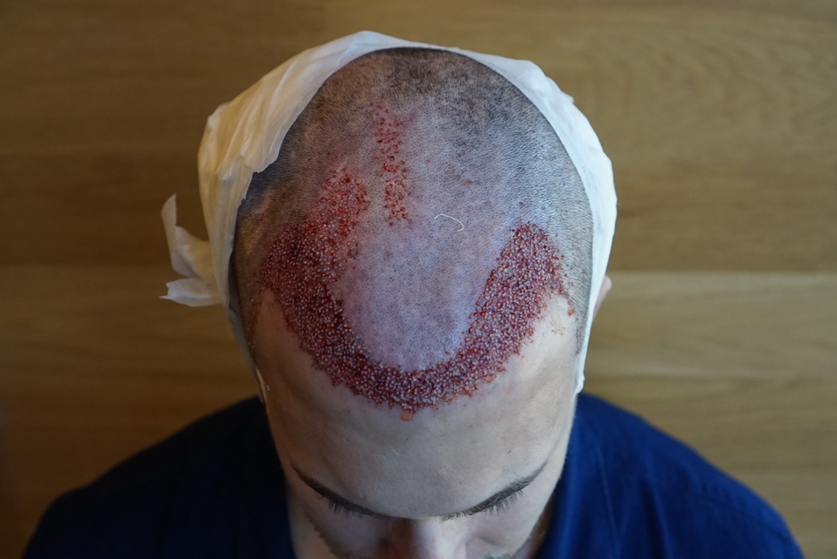 hurly post hair transplant surgery