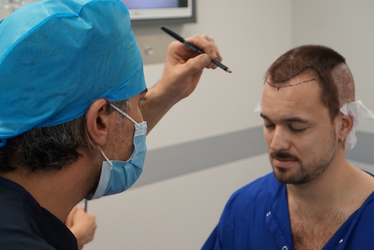 hair transplant surgery Adam Hurly