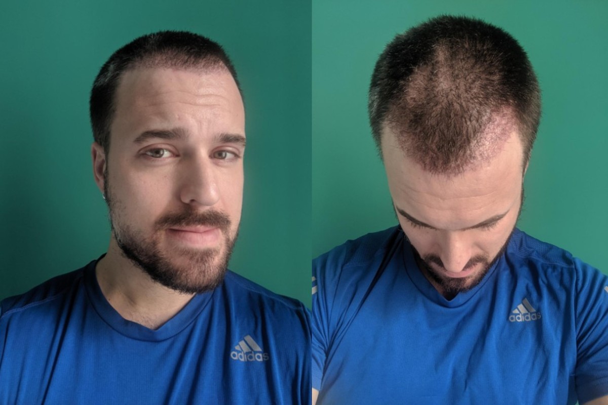 Hair transplant Adam Hurly surgery progress