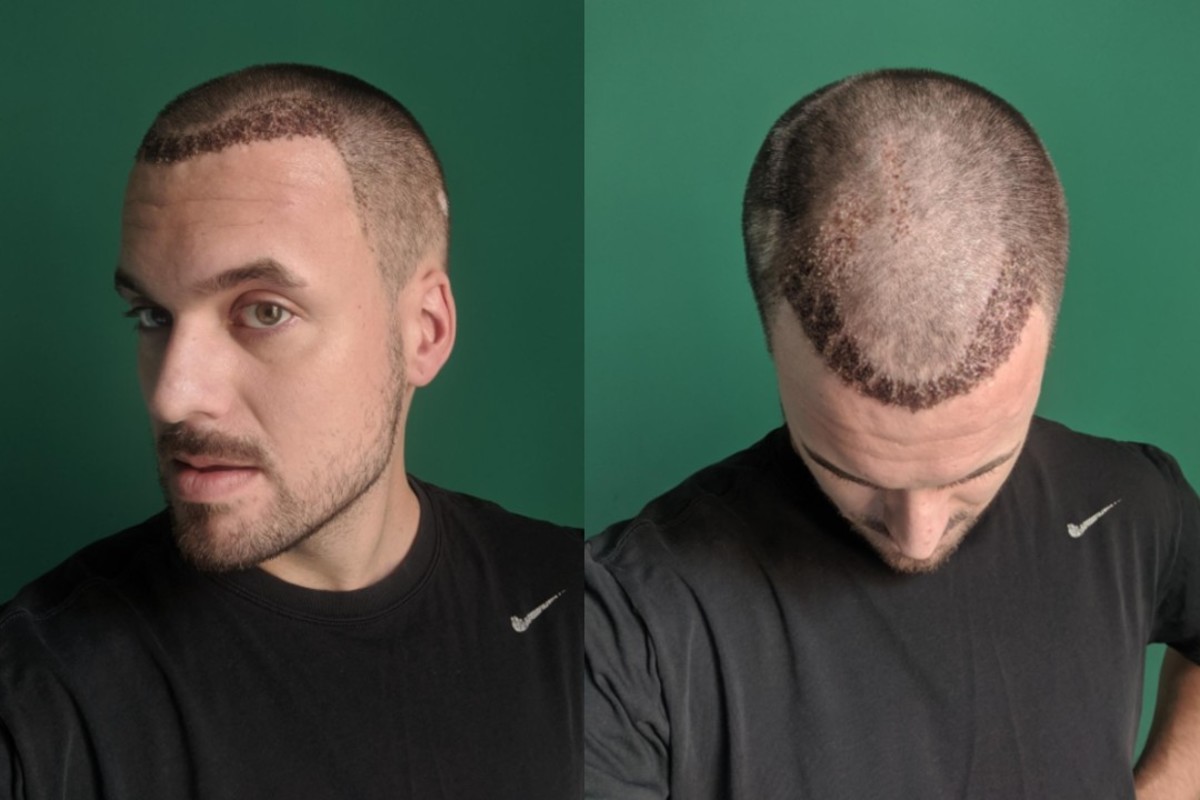 Hair transplant Adam Hurly surgery progress