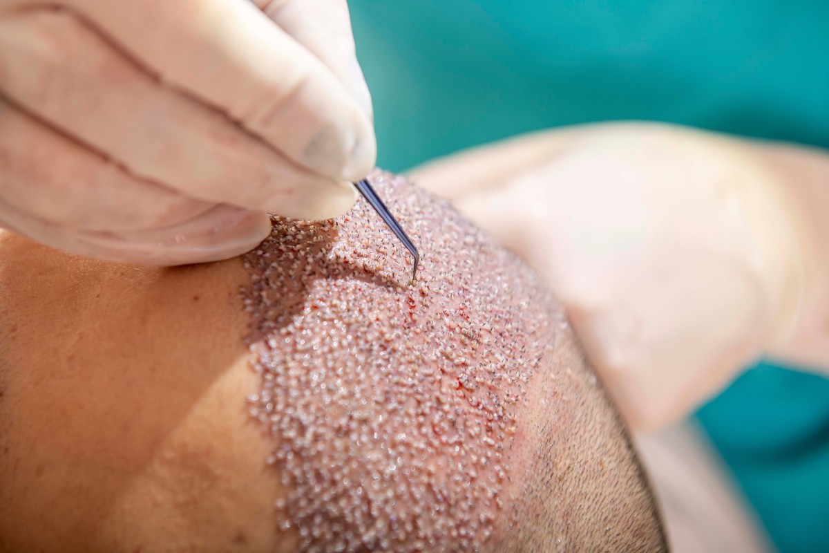 Hair transplant surgery