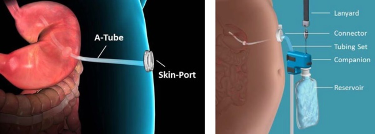 The AspireAssist obesity device. Photo via U.S. Food and Drug Administration. The AspireAssist obesity device. Photo via U.S. Food and Drug Administration.